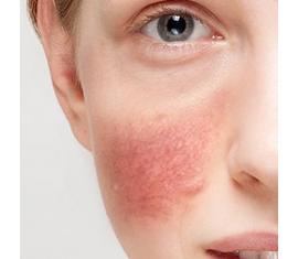 Rosacea, kipirosodás, ekcéma Rosacea, kipirosodás, ekcéma