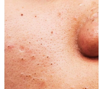 Mitteszerek, tág pórusok