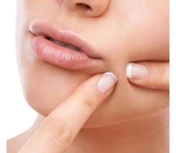 Pattanások, zsíros bőr