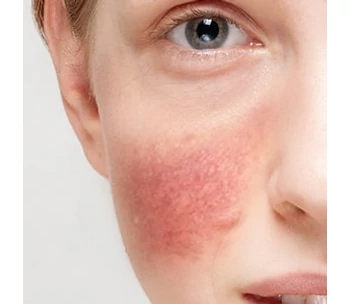 Rosacea, kipirosodás, ekcéma